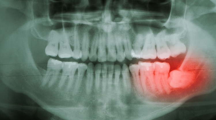 X-ray showing an impacted wisdom tooth in the lower jaw.